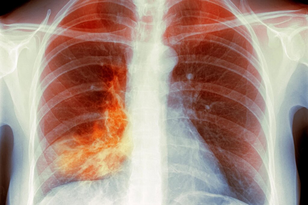 'White lung pneumonia' – what it’s good to know