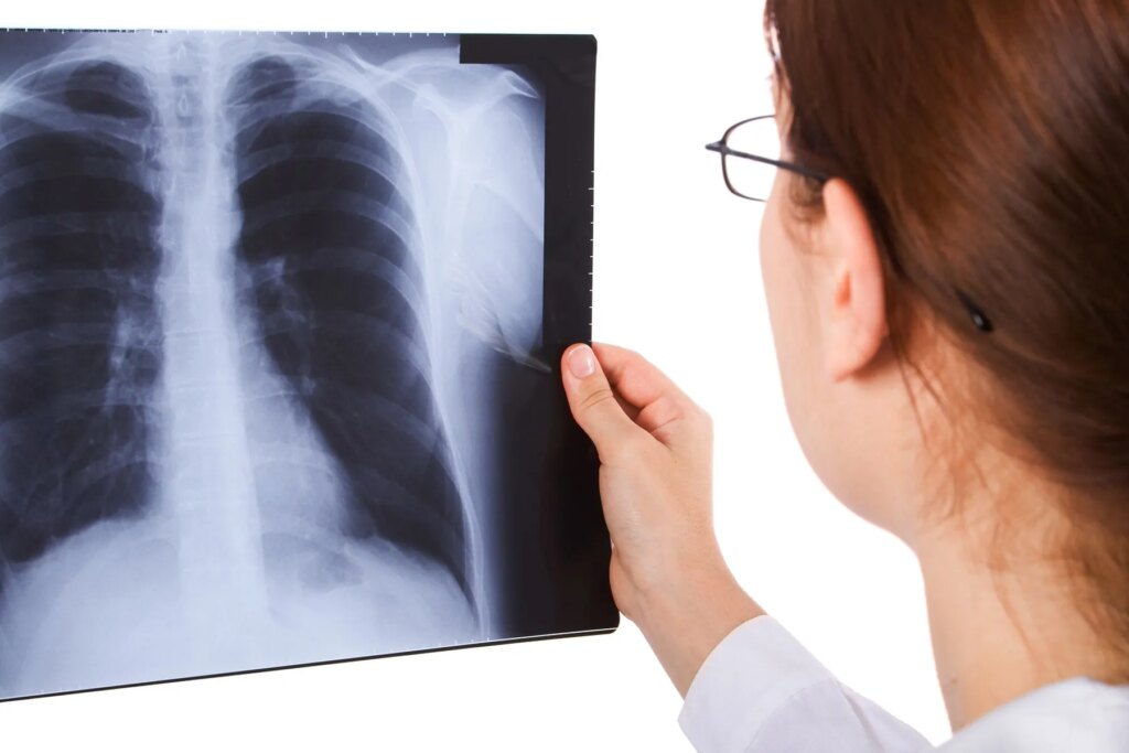 Lung most cancers in girls who’ve by no means smoked Lung most cancers in girls who’ve by no means smoked