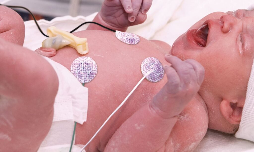 Preset ECG electrodes present promise in neonates requiring superior resuscitation