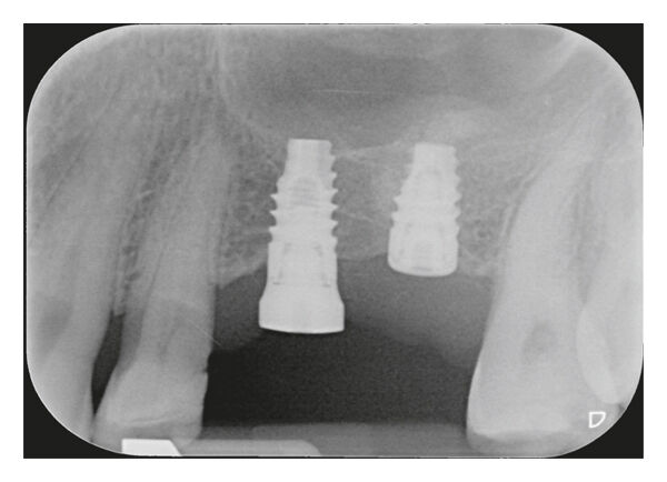 Placement of 6mm and 11mm implants for mixed sinus flooring augmentation