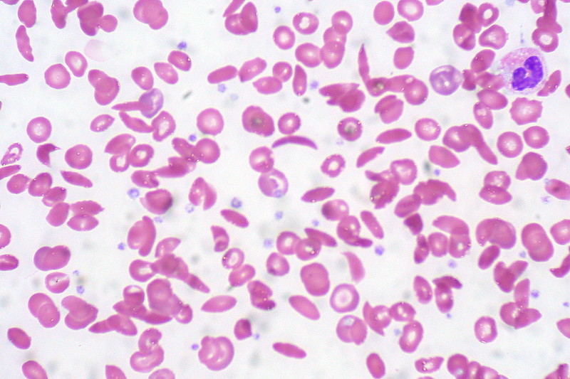 FDA approves not one, however two gene therapies for sickle cell illness