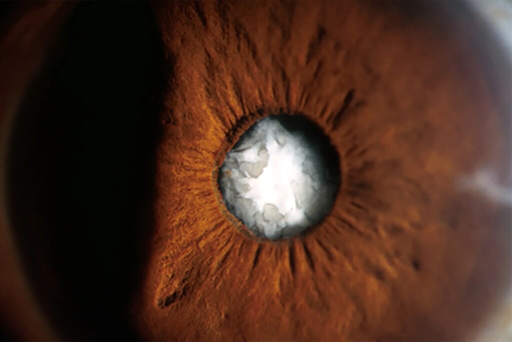 Cataract surgical procedure tough for folks with a earlier radial keratotomy