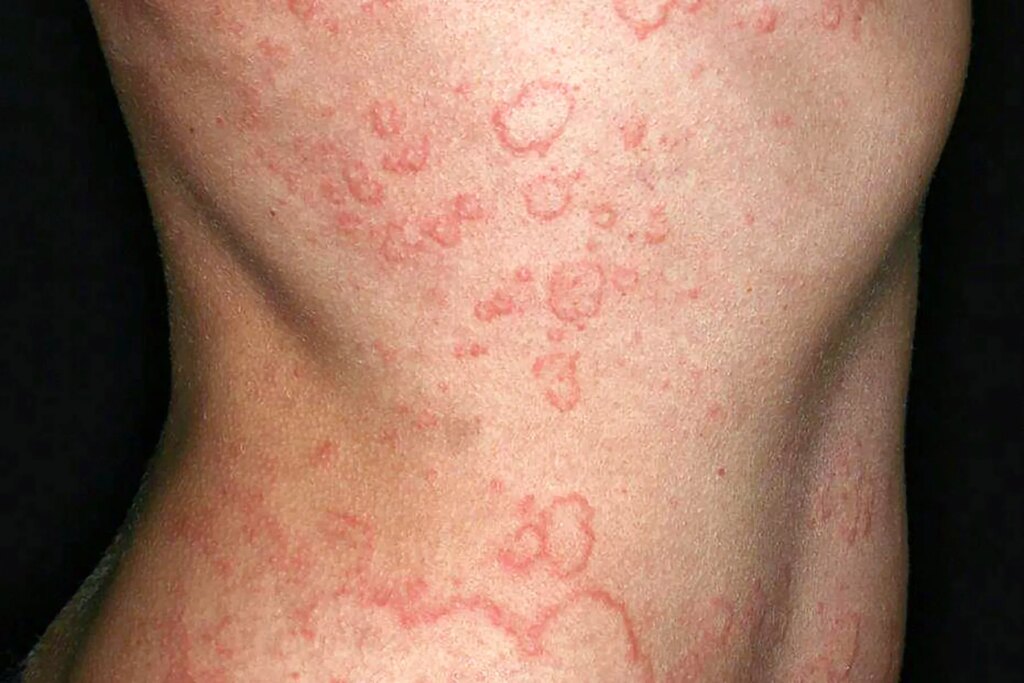 Power spontaneous urticaria: what it is advisable to know