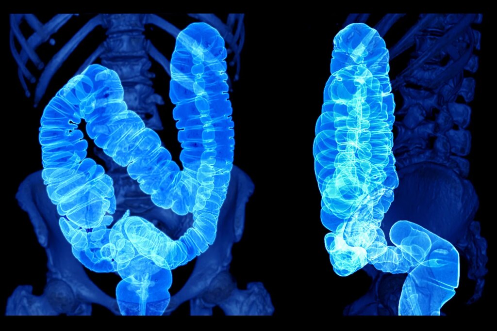 Behind the spike in colorectal most cancers amongst younger People