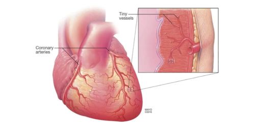 Hourglass-shaped stent may ease extreme chest ache attributable to microvascular illness – The Journal of Healthcare Contracting