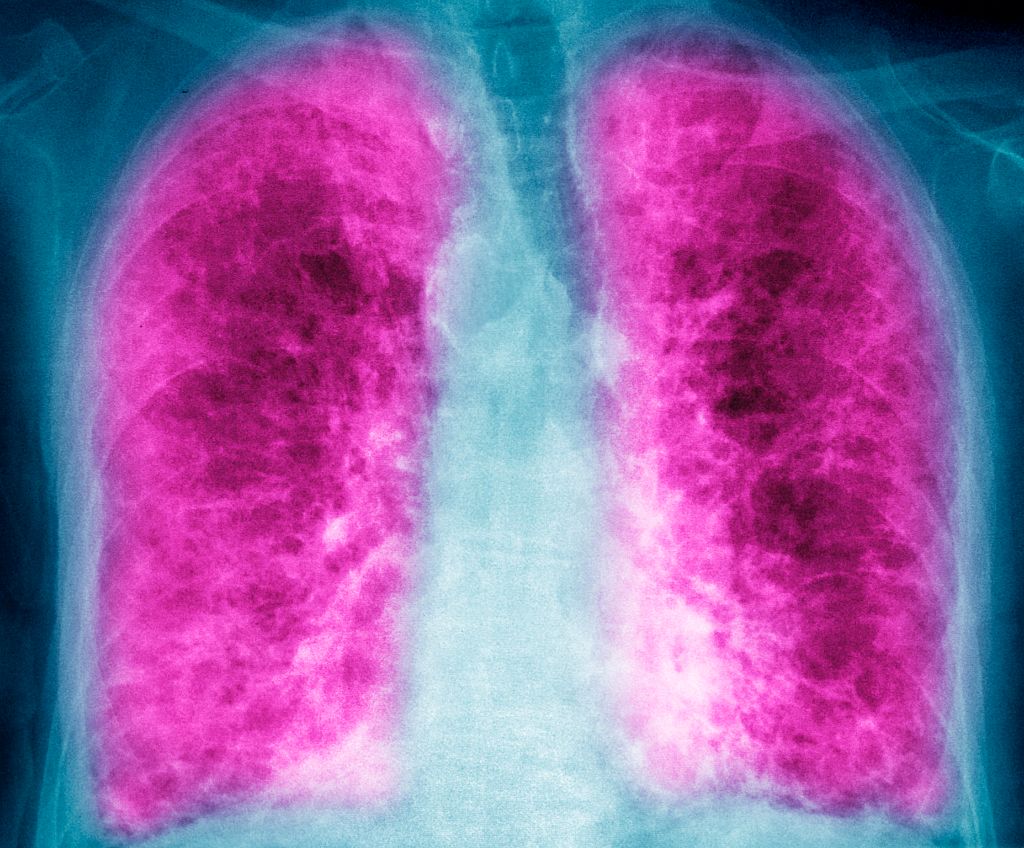 A biotech startup's quest to alleviate pulmonary mucus obstruction for respiratory care