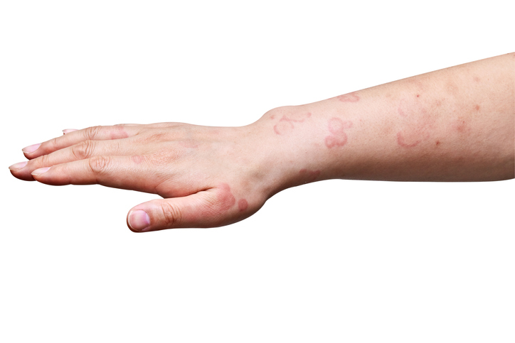 Blockbuster Sanofi & Regeneron Drug Dupixent notches FDA nod for inflammatory pores and skin illness