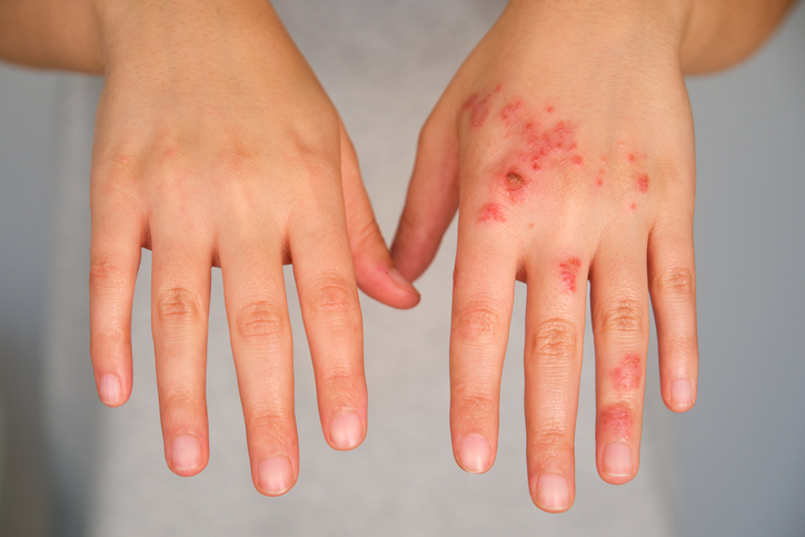 Nektar's new eczema medicine is on check objectives, however Dupixent differentiation stays unclear Nektar's new eczema medicine is on check objectives, however Dupixent differentiation stays unclear
