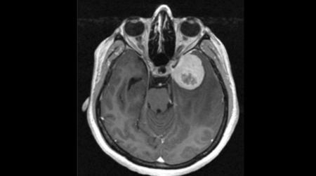 New genetic biomarker marks aggressive mind tumors – The Journal of Healthcare Contracting
