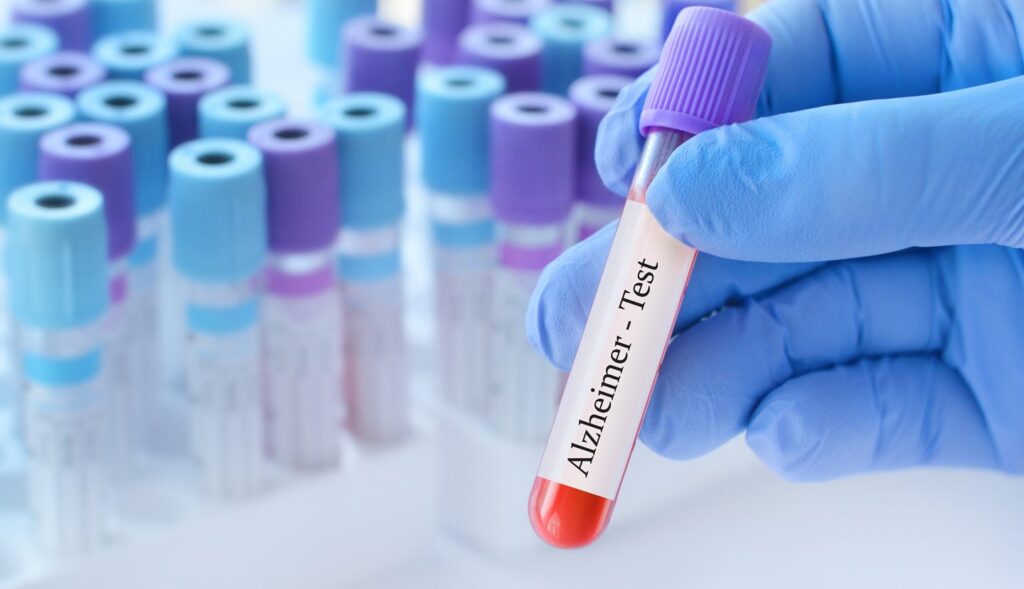 FDA to assessment eisai’s leqembi sbla sbla for alzheimer’s illness FDA to assessment eisai’s leqembi sbla sbla for alzheimer’s illness