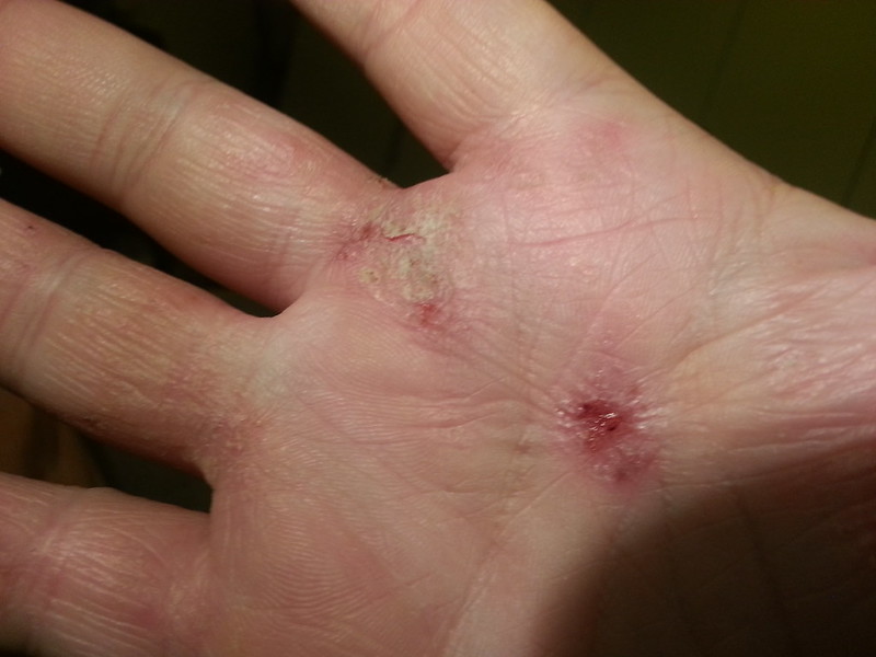 Evommune begins to argue towards the dominance of Sanofi’s Dupixent in atopic dermatitis