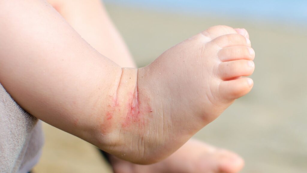 Arcutis studies constructive topline information within the Zoryve examine for pediatric AD Arcutis studies constructive topline information within the Zoryve examine for pediatric AD