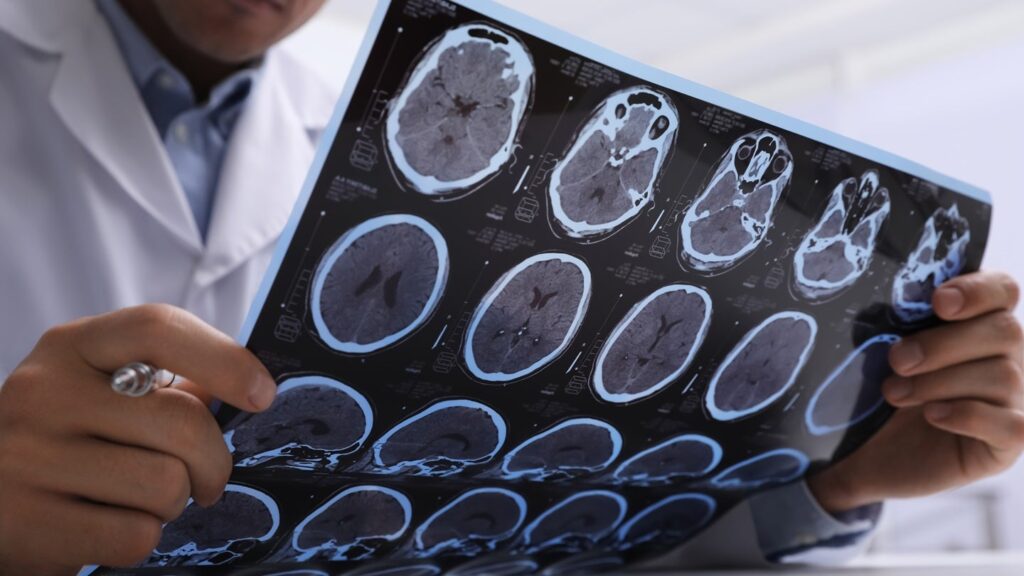 Genentech studies fenebrutinib Part III outcomes for PPMS