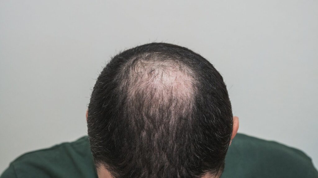 Veradermics completes enrollment within the second Section III examine VDPHL01