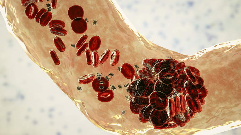 Bayer reveals knowledge that might make stroke prevention drug its subsequent blockbuster product