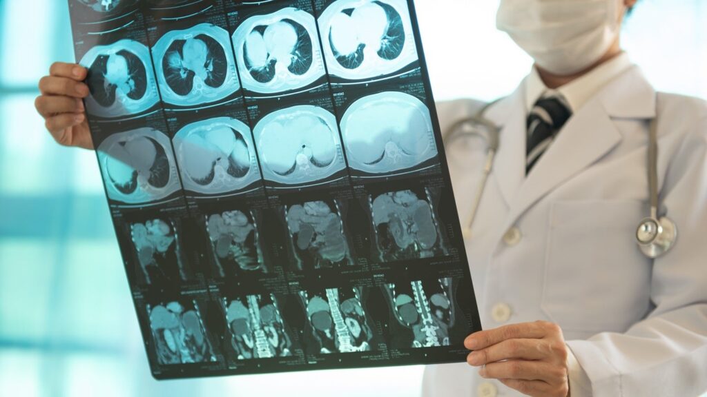 AngioDynamics Expands European Indications for NanoKnife System AngioDynamics Expands European Indications for NanoKnife System