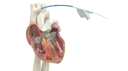 Medtronic Receives FDA Approval for New Cardiac Innovation – The Journal of Healthcare Contracting
