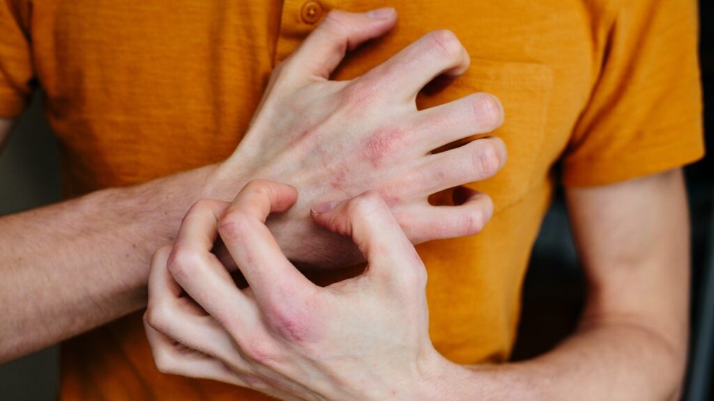 Oruka stories constructive information from the Part IIa trial for plaque psoriasis