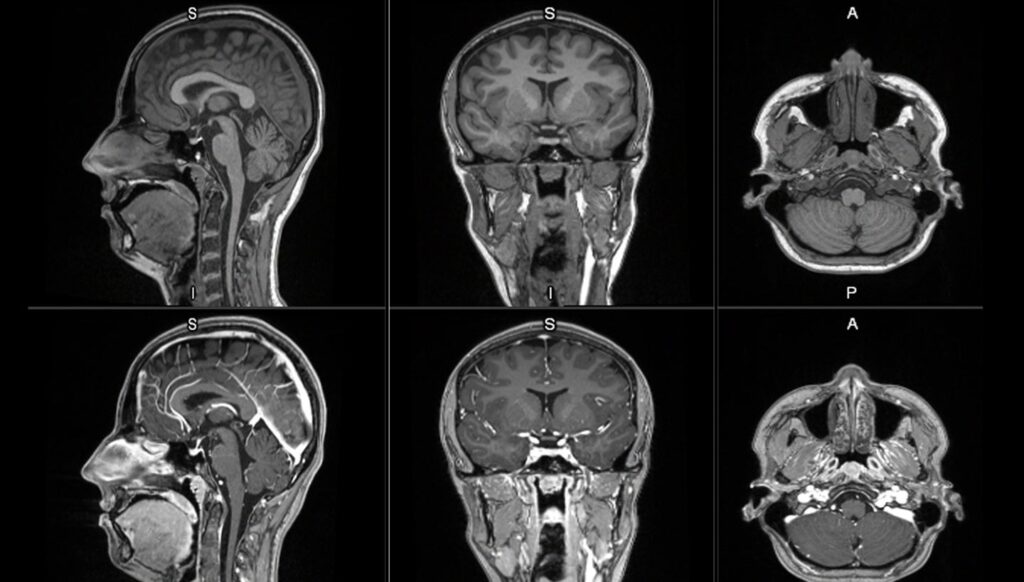 First affected person to obtain a dose in GE HealthCare’s Part II/III LUMINA scientific trial