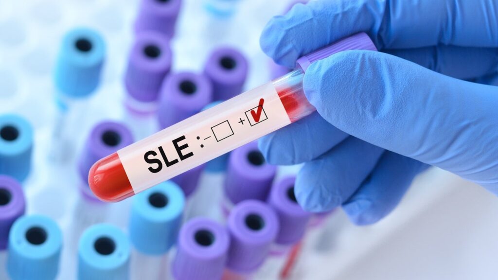 FDA Approves AstraZeneca’s Saphnelo for SLE